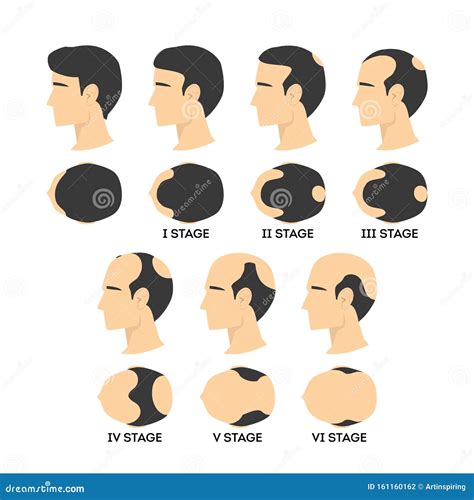 Alopecia Stages Set. Female Balding In Process. Vector Illustration ...