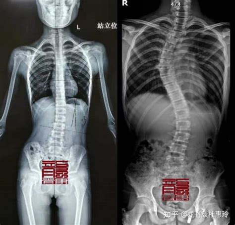 怀疑孩子脊柱侧弯，x线检查要怎么做？ 知乎