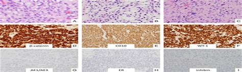 Ovarian Microcystic Stromal Tumor With Intraovarian Recurren