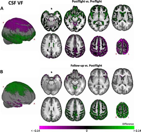 Whole-brain CSF VF changes from pre-to postflight and from postflight ...