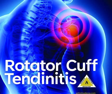 Treatment For Rotator Cuff Tendinitis Shoulder Pain Arthritis