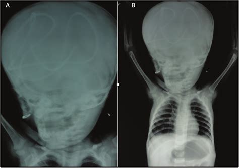 X Ray Skull Ap View Showing Intracranial Migration Of Vp Shunt Coiled