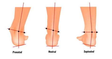 Overpronation Foot Biomechanics Signs Symptoms And Related Injuries