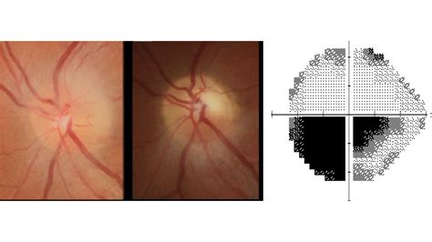 NEUROPATIA ÓPTICA ISQUÊMICA ANTERIOR NOIA Dra Ana Suzuki