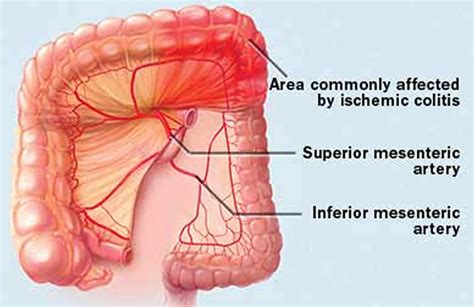 Ischemic Colitis - Causes, Signs, Symptoms, Complications, Treatment