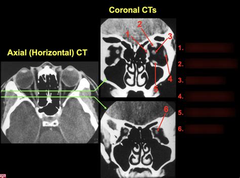 Eye Ct Diagram Quizlet