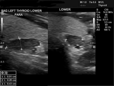 Parathyroid Adenoma Ultrasound