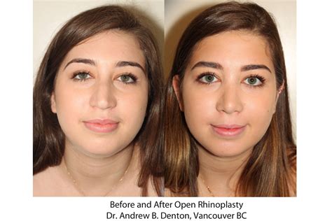 Before And After Open Rhinoplasty Dr Andrew B Denton Vancouver BC