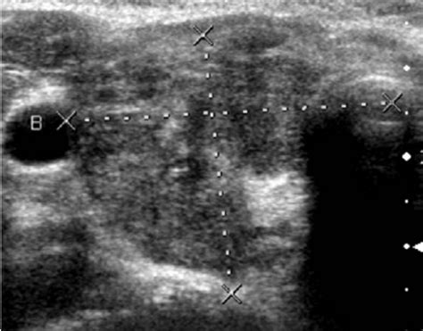 Ultrasonography Of Case With Medullary Thyroid Cancer With Hypoechoic