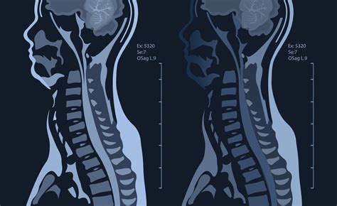 MRI Of The Cervical Spine With And Without Contrast MRI With Bilateral