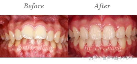 重庆牙齿矫正（正畸）案例【上牙前突下颌后缩深覆合深覆盖牙列拥挤】 知乎