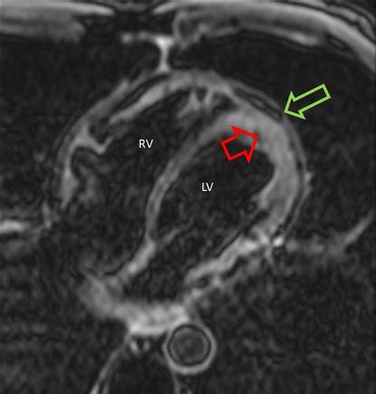 Constrictive Pericarditis Image Radiopaedia Org