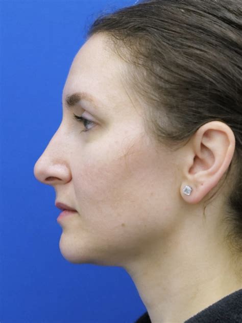 Cases In Rhinoplasty Tip Only Mao Facial Plastics