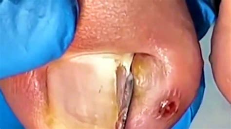 Huge Ingrown Toenail YouTube