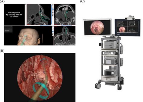 Augmented Reality Enhanced Navigation In Endoscopic Sinus Surgery A