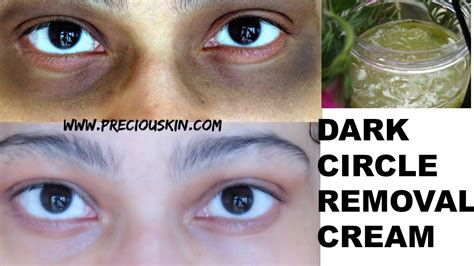 Reduce Lighten Dark Circles In Just 7 Days Aloe Vera Dark Circle