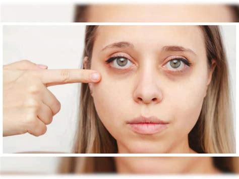 5 Vitamin Deficiencies That Can Cause Dark Circles Under Your Eyes