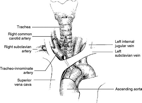 Common Tracheostomy Issues Core Em