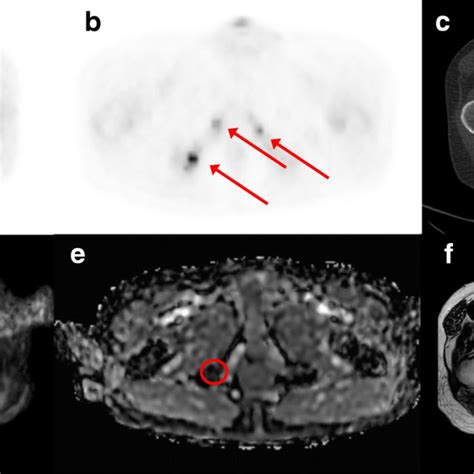 Example Of A Patient With Bone Metastases In The Right Iliac Bone Download Scientific Diagram