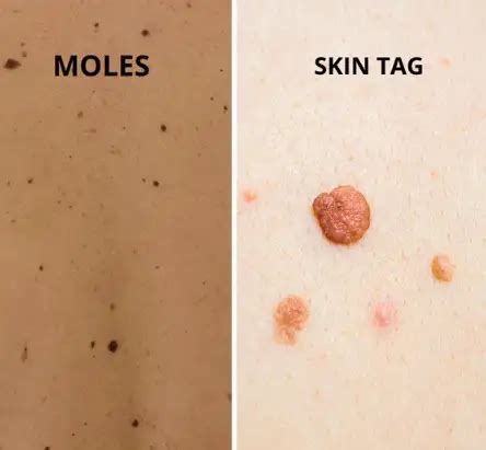 10 Best Skin Tag Removal Consumer Reviews And Reports In 2024