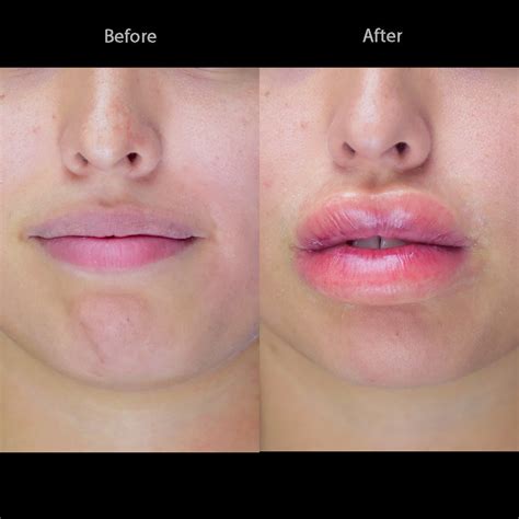 Swollen Lips Causes Symptoms And Treatment 2023 Wyndly 55 Off