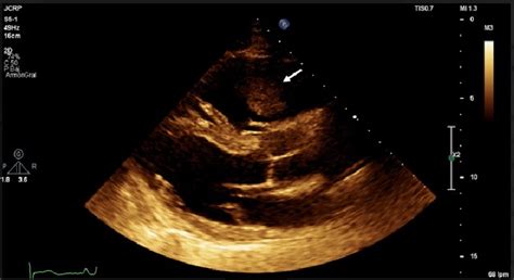 Plax Showing A Clot In Transit In The Right Ventricle Arrow