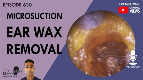 630 Ear Wax Removal Microsuction Youtube