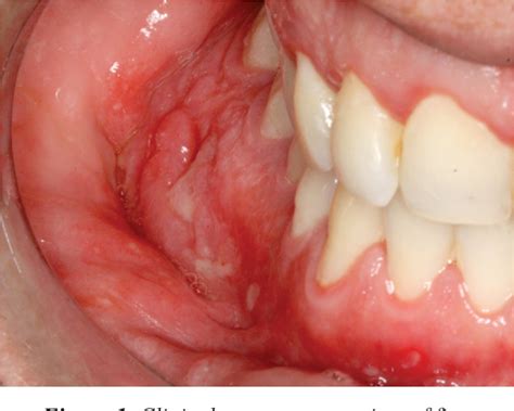 Figure 1 From Oral Manifestations Of Crohn S Disease A Case Report Semantic Scholar