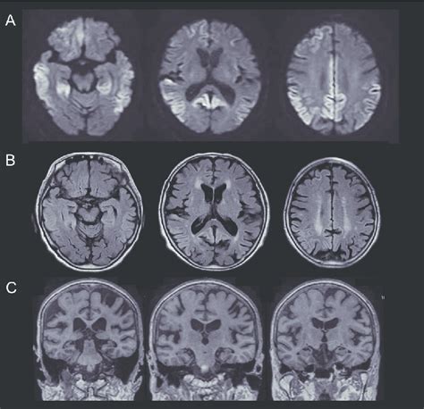 Brain MRI On Admission A Axial Diffusion Weighted Imaging Shows