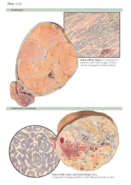 Testicular Tumors I Seminoma Embryonal Carcinoma Yolk Sac Tumors Pediagenosis