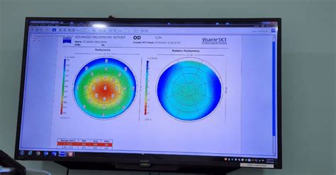 Review Relex Smile Flapless Eye Surgery For Myopia Correction