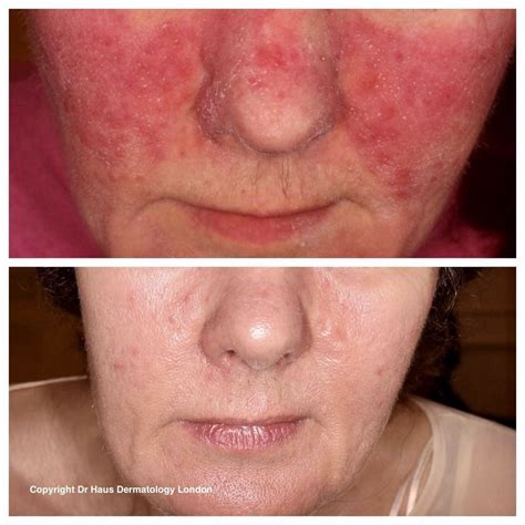 Best Rosacea Treatment | Dr. Haus Dermatology