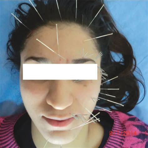 Pdf Bell Palsy And Acupuncture Treatment