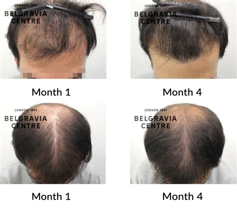 Hair Loss Success Story I Am Very Pleased With The Results So Far