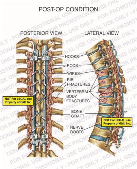 Post Op Condition 95086ba Generic Medical Legal Exhibits A Division Of Mvi