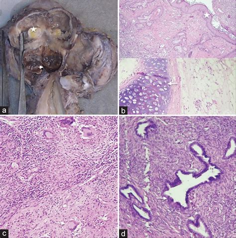 Diagnostic Dilemma Ovarian Dermoid Cysts Presenting With Uncommon