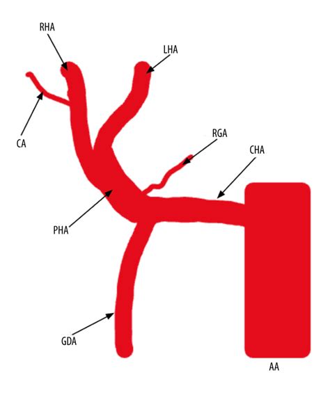 Hepatic Artery