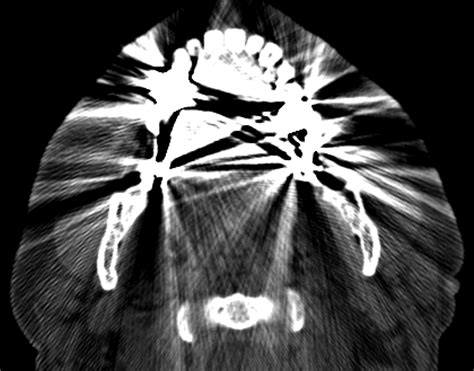 Revision Radiology Ct Metal Artifact Reduction Using The Metal