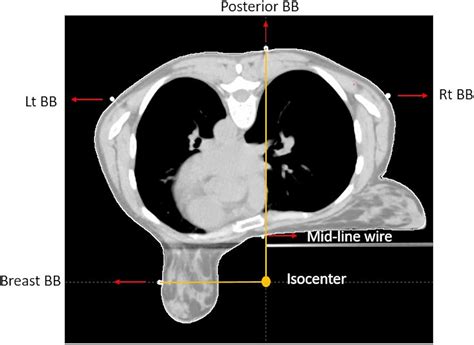 Frontiers | Accelerated partial breast irradiation in early stage