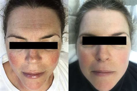 Facial Redness And Rosacea Before And After Treatment Palm Clinic