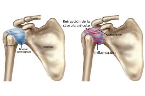 Hombro Congelado O Capsulitis De Hombro Enrique Garc A Ballesteros