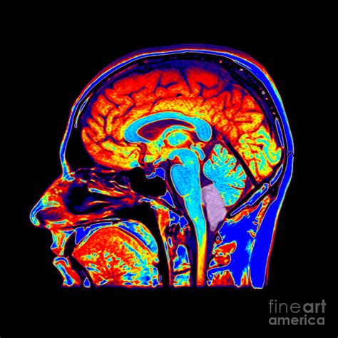 Mri Of Chiari I Malformation Photograph by Living Art Enterprises | Pixels