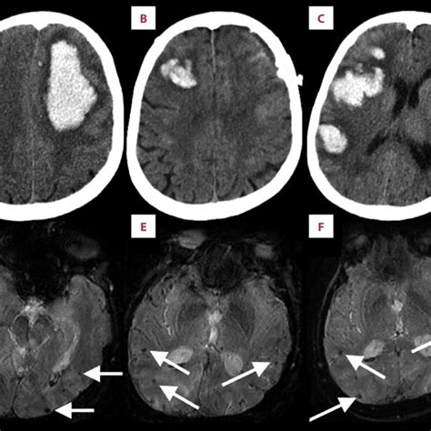 (A-C) CT head images. CT head scan on admission (A), one week later... | Download Scientific Diagram