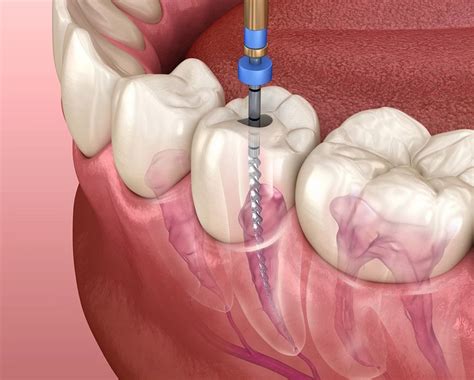 Leczenie Kana Owe Pod Mikroskopem Endodoncja Mikroskopowa Zielona G Ra