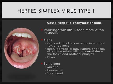 Disease State Presentation: Herpes Simplex Virus