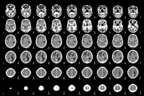 Tomografía computarizada del cerebro vistas axiales para evaluar el