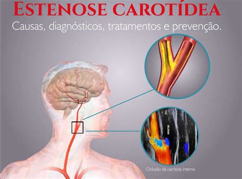 Estenose carotídea Causas diagnóstico tratamentos e prevenção