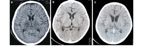 Fogging Of Thalamic Lesions In A Patient With Japanese