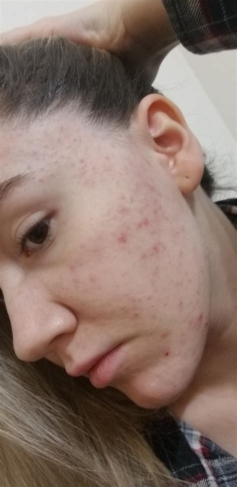 Whiteheads?? What's the best way to get rid of hundreds of tiny bumps