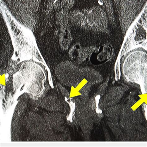 Computed tomography (CT) scan of the pelvis | Download Scientific Diagram